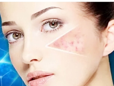 激光治疗痘印恢复时间多久 激光治疗痘印恢复时间多久