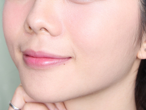 苹果肌注射玻尿酸会不会肿胀 苹果肌注射玻尿酸会不会肿胀