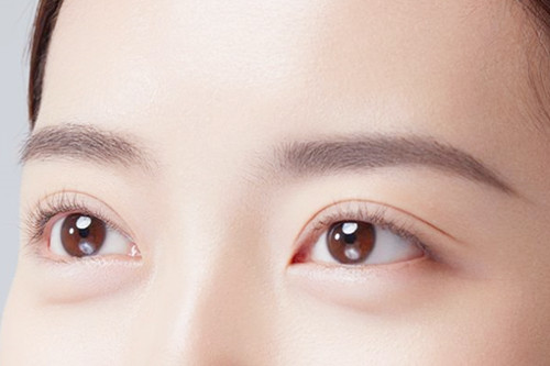 开内眼角恢复需要多长时间 开内眼角恢复需要多长时间