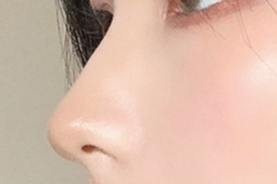 鼻假体取出后多久恢复 鼻假体取出后多久恢复